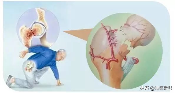 老年人的最后一次骨折,老年人请谨防人生最后一次骨折