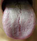 中医舌诊从零开始学齿痕舌,国医大师柴嵩岩舌诊