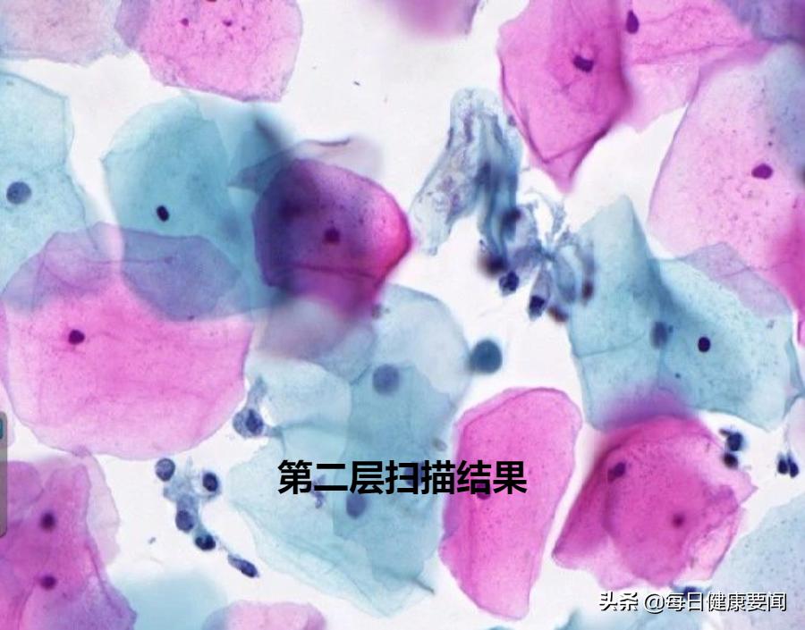 打过宫颈癌针需要查有没有抗体吗,35-45岁打宫颈癌疫苗最适合打几价