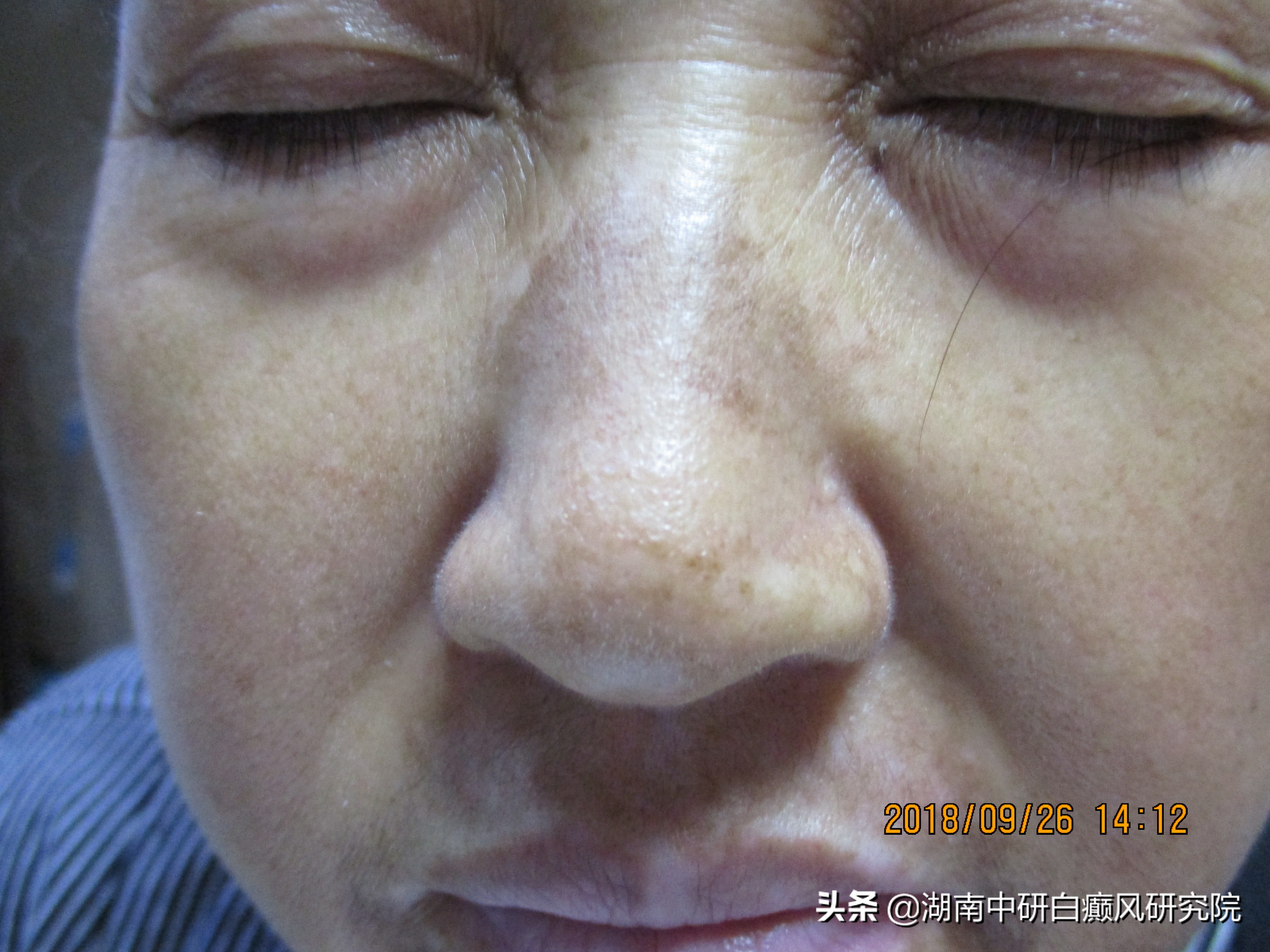 一位面部白癜风的患者，从患白到康复，她经历了什么？