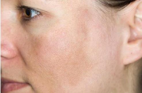 脖子被太阳晒黑了怎么才能变白,被太阳晒黑怎样变白女生