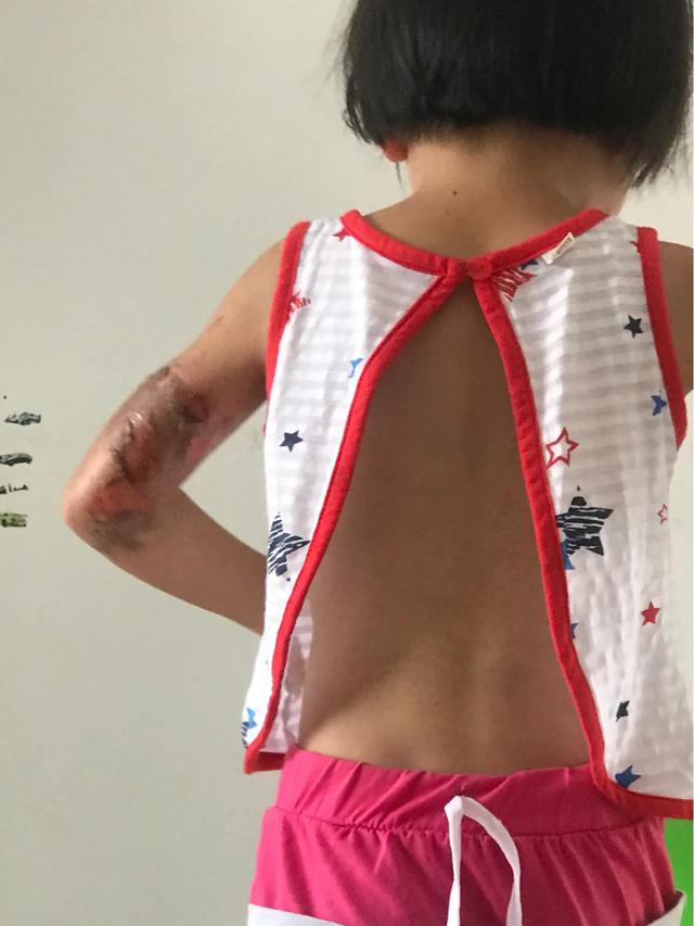 孩子大面积烫伤治疗流程,记录女儿被烫伤到治疗全过程