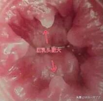 肛乳头“瘤”是不是一定要立刻手术？