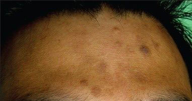 脸上痘印痘坑怎么消除最有效,痘坑怎么才能彻底解决