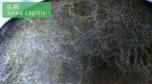梦禾科普｜如何对付烦人的头皮屑