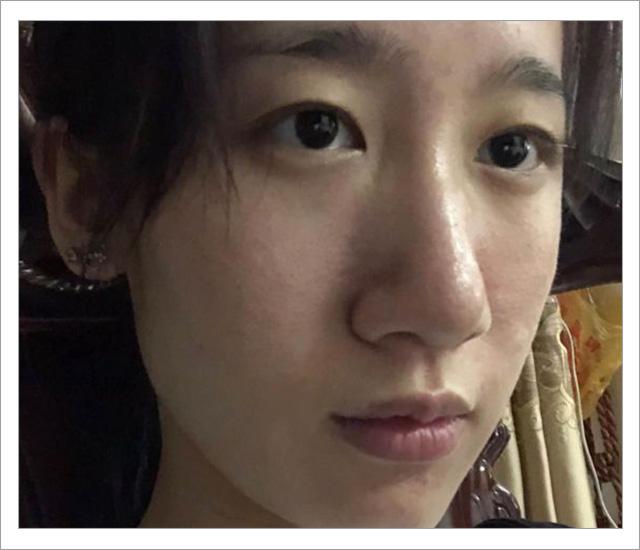 脸上螨虫的正确消灭方法,脸上的螨虫能不能彻底消灭