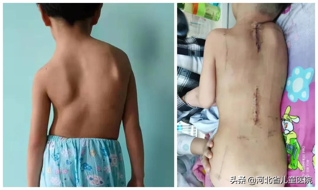 为河北省儿童医院点赞！一台手术让孩子长高5厘米！