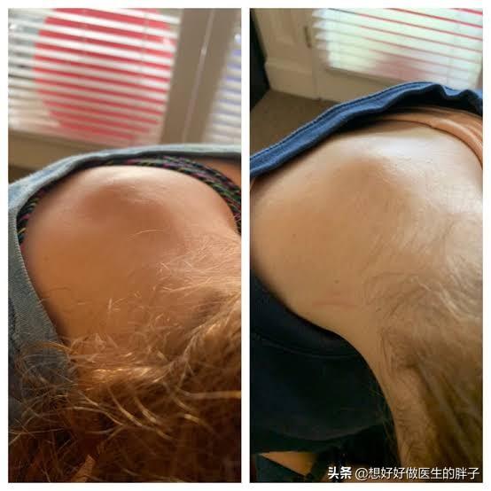 颈椎病和肥胖有关系么,脖子后面有堆肉是颈椎出问题了吗