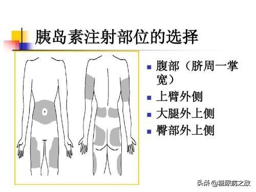 糖友你们的胰岛素针头多久换一次,老糖友胰岛素针头用几次