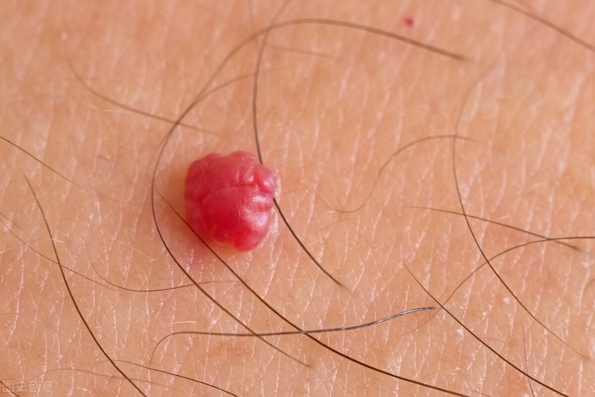 身体有疣是不是体内有hpv病毒,女性长出疣体是很严重的病吗