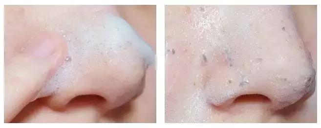 洗脸清洗黑头,洗脸清洁去粉刺