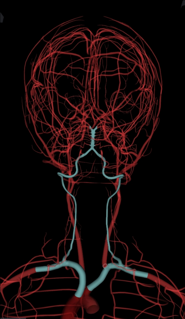 颈部血管椎动脉分段解剖图,椎动脉横断面图