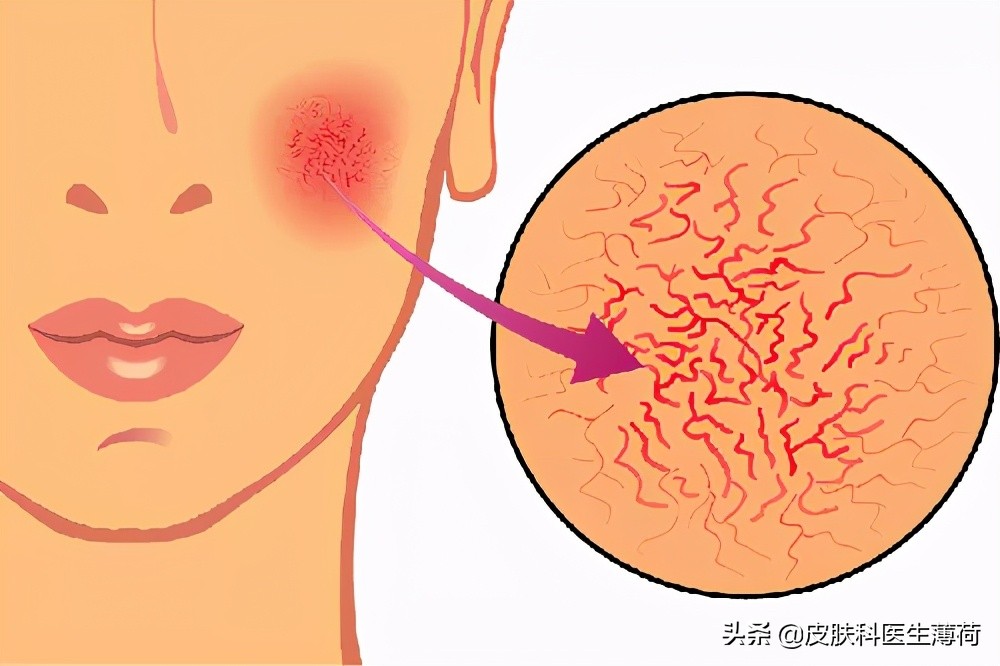 皮肤科医生推荐的去痘印的药,皮肤痘印怎么做才能彻底修复