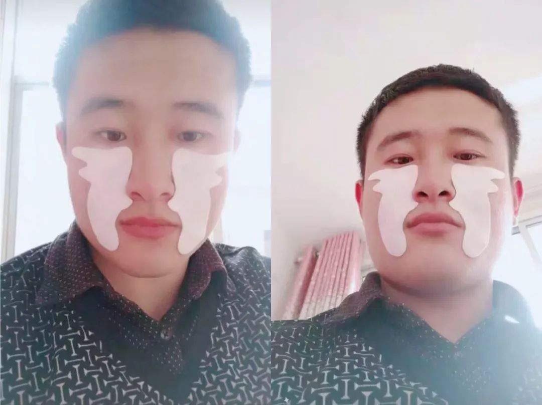 眼部细纹去皱的方法,眼角皱纹多用什么抗皱纹