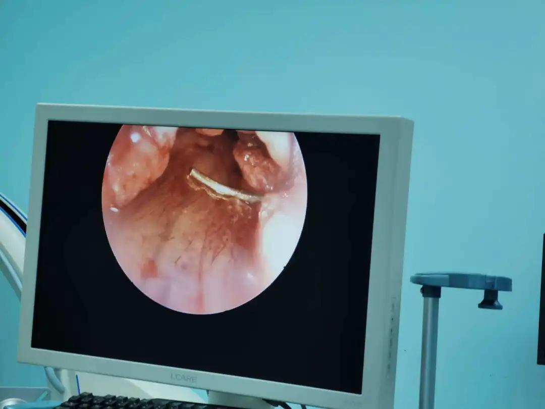 女子出现手麻,拖延1年后就医,手掌这地方已“瘪”掉!年轻人易中招