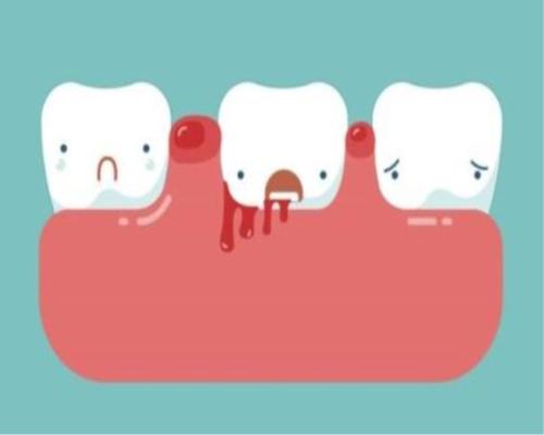 导致牙龈萎缩的4个原因,导致牙龈萎缩的4大原因