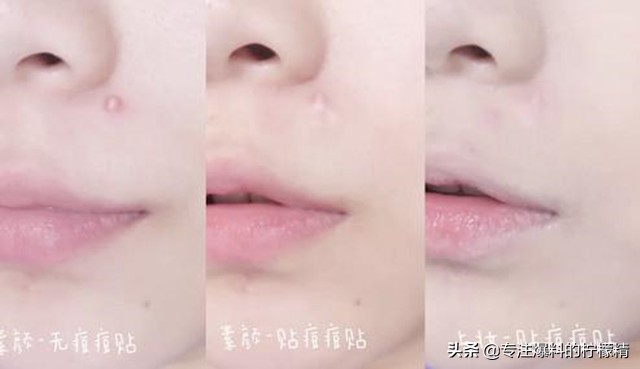 片仔癀的祛痘产品怎么样,片仔癀祛痘贴评价