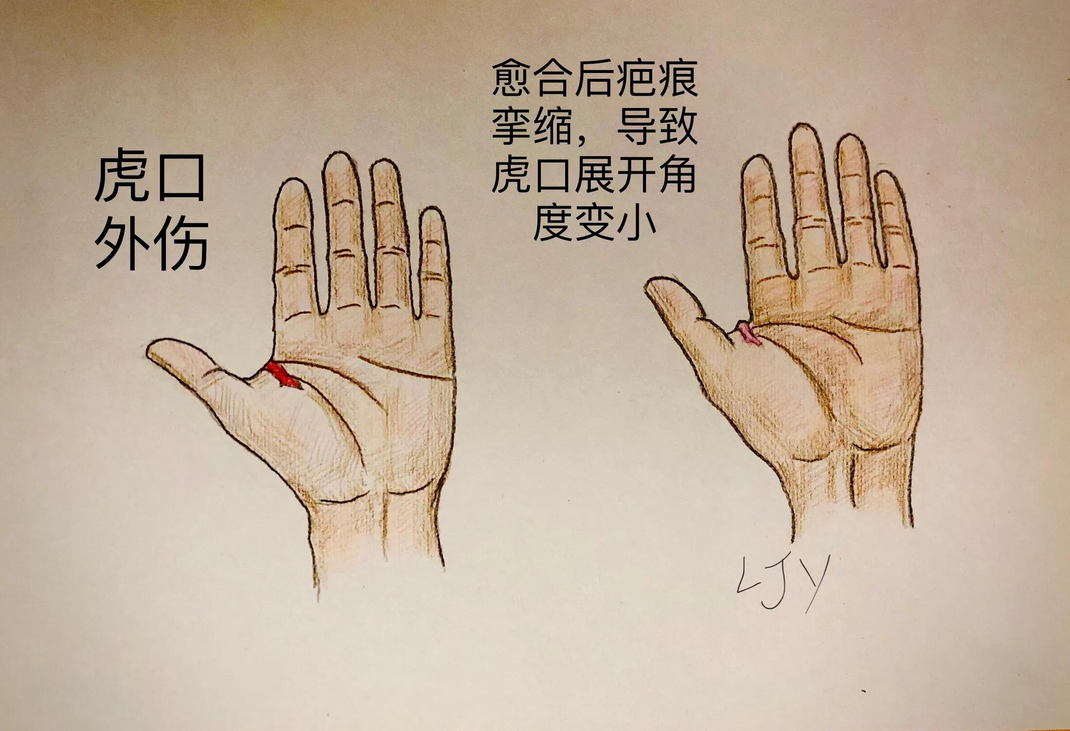 手被割伤如何处理,手被割伤了较深要如何处理