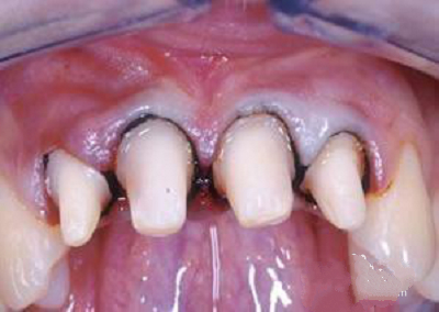 烤瓷牙做了人变丑了,烤瓷牙套里的牙烂了有什么症状