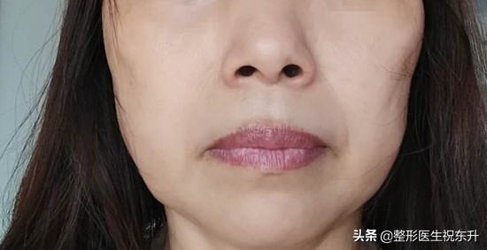 有的瘦脸针打了脸会酸有的没感觉,打完除皱针脸部看上去很奇怪