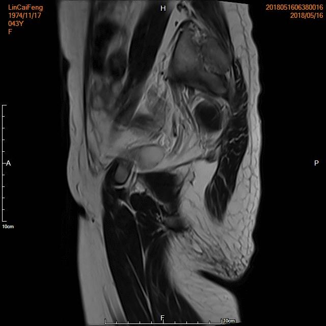 「不死的癌症」之克星——子宫腺肌症介入栓塞治疗