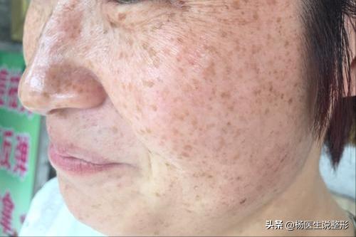 遗传性雀斑几岁可以激光祛斑,激光祛斑能不能根治雀斑