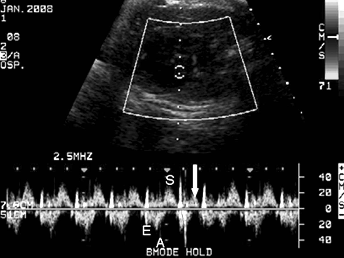 胎儿超声结果显示心跳过速,27周胎儿心律不齐早搏