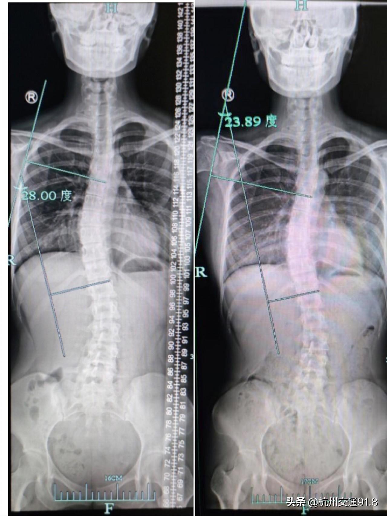孩子为何斜着身子走路?原来是脊柱有问题