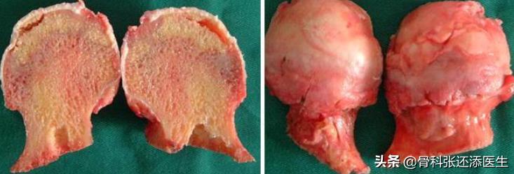 老年人股骨颈骨折会股骨头坏死吗,老年人股骨头摔断能治愈吗