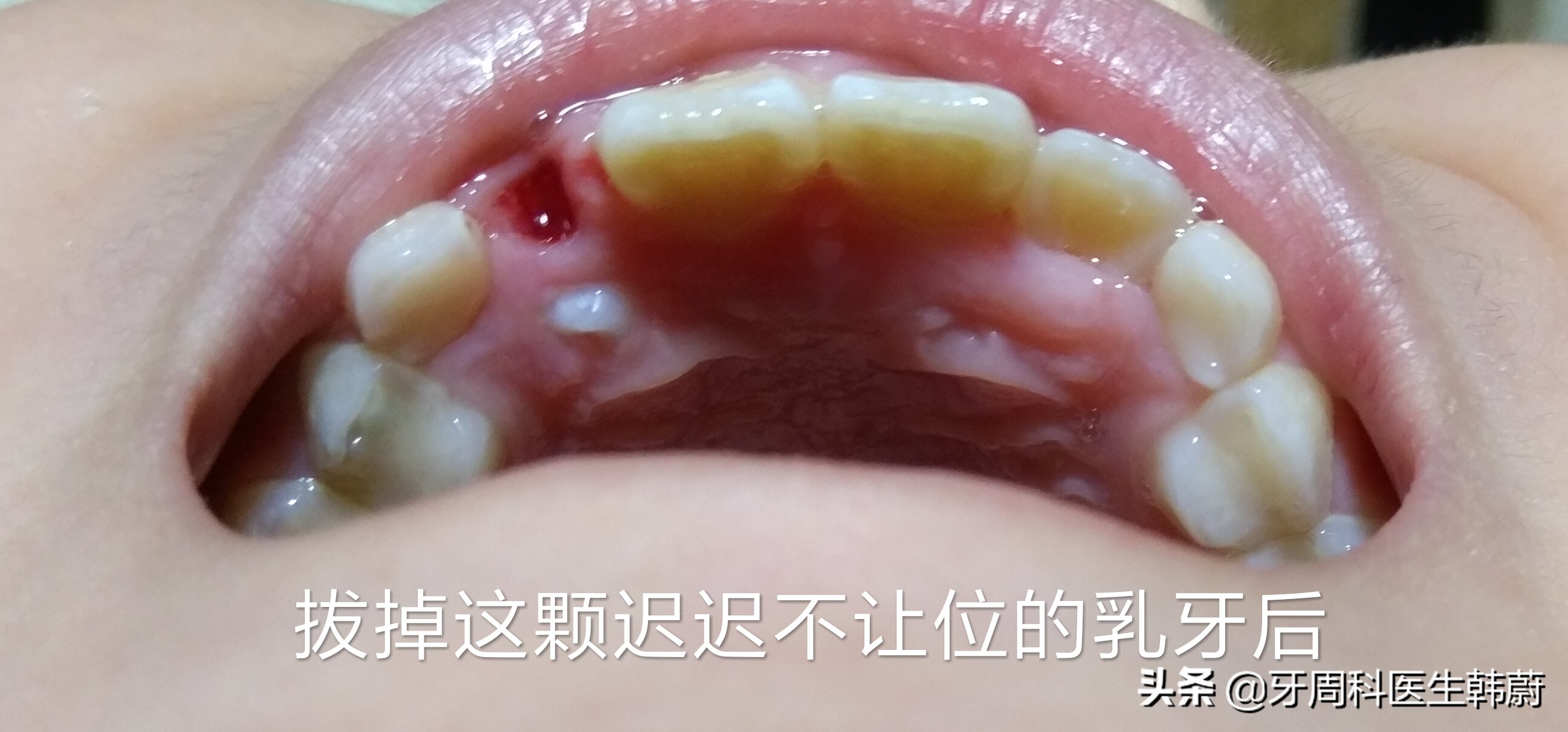 宝宝长双层牙乳牙怎么拔掉,6岁小孩长双层牙必须拔掉吗