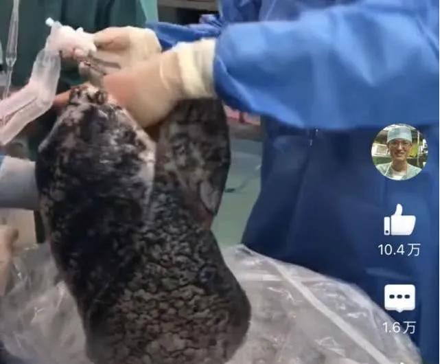 长期抽烟肺部变黑会影响生命吗,抽烟肺部有阴影戒烟后会消除吗