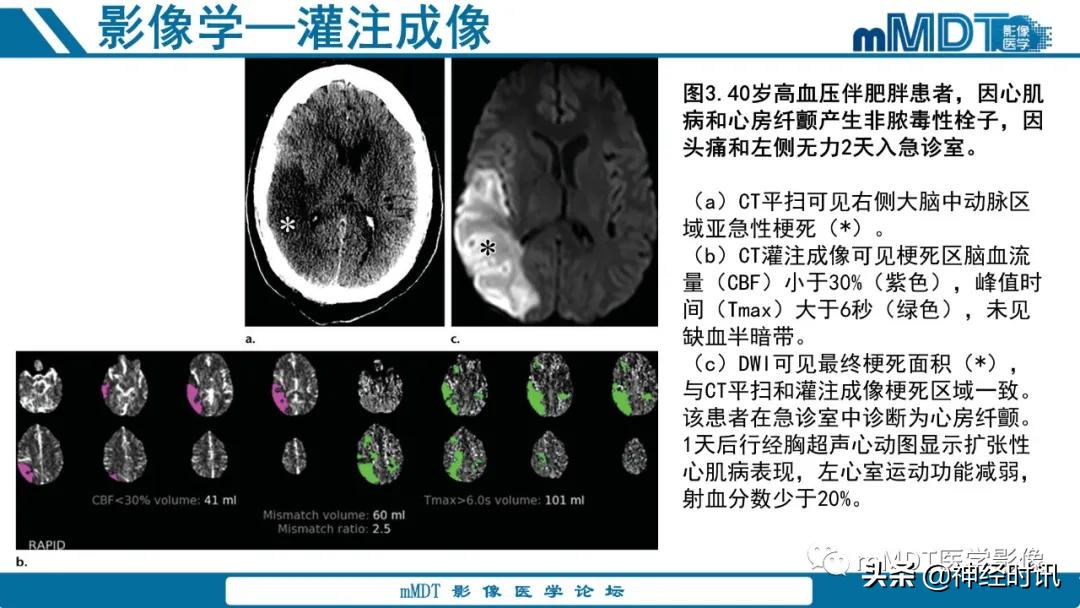 急性缺血性脑卒中ppt素材图片,青年缺血性脑卒中ppt