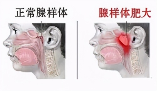 苏州医院治儿童耳鼻喉,儿童医院耳鼻喉义诊