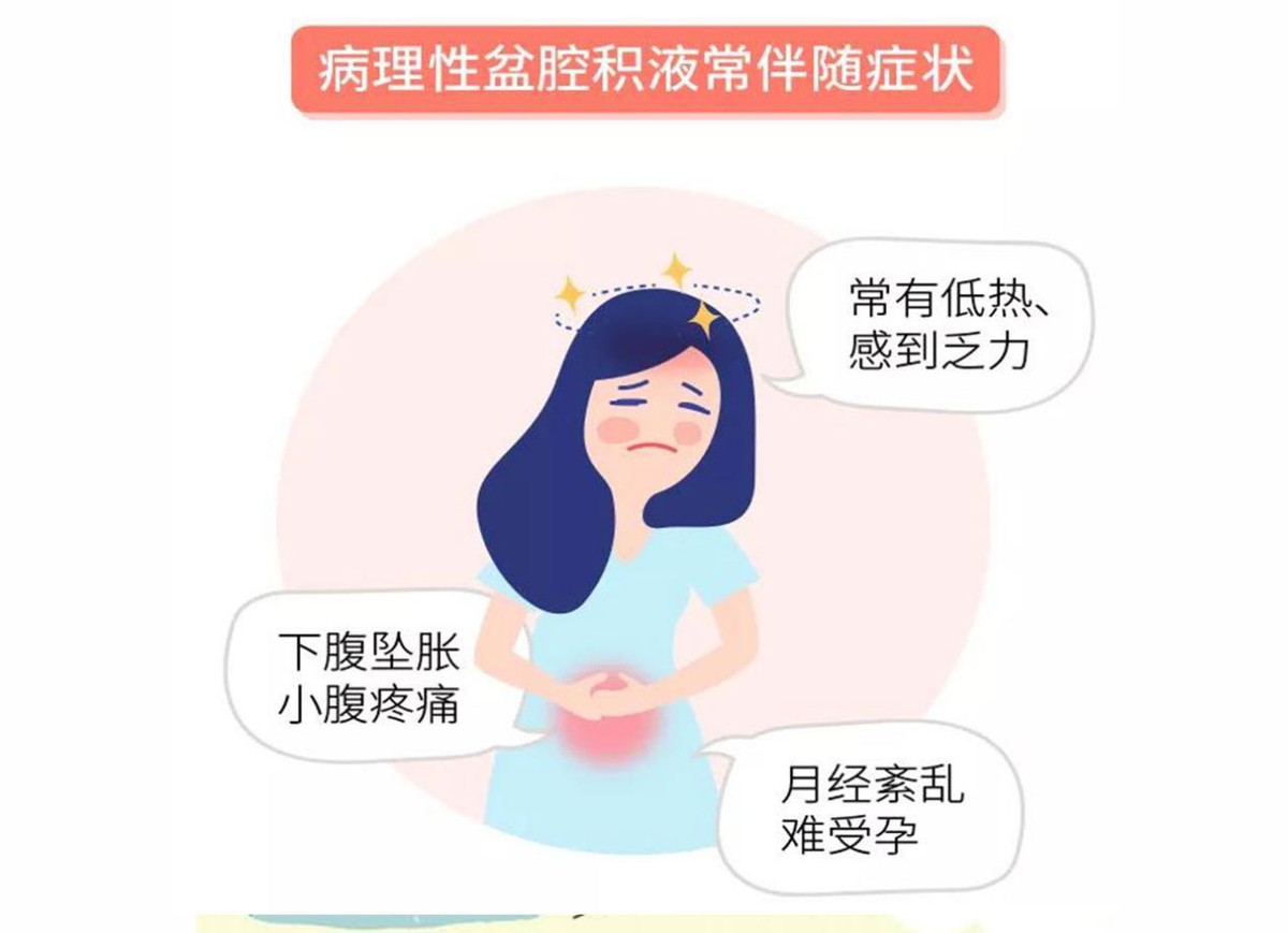 患上盆腔积液后怎么治,得了盆腔积液是输液还是吃药