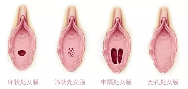 处女不能用卫生棉条？你对女人的偏见太大了！