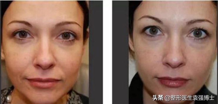 祛除法令纹最有效最自然的方法,淡化法令纹真正有效果的方法