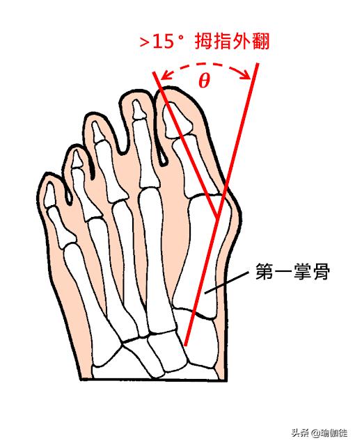 拇外翻大脚趾疼如何在家就能治,如何判断拇外翻造成的脚疼