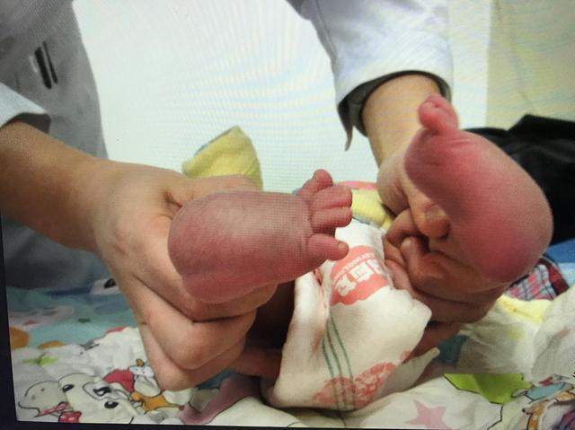 小孩出生脚内翻,宝宝出生脚有一个足内翻怎么办