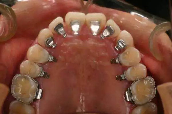 矫牙经历的几个阶段,矫牙过程难受吗