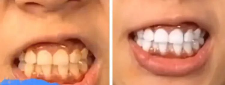 网红竹炭牙膏真的有用吗 (抖音竹炭洗白牙膏是真的吗)