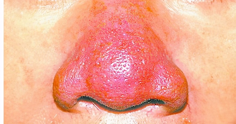 中医倪海厦治疗酒渣鼻,中医酒渣鼻是什么原因引起的