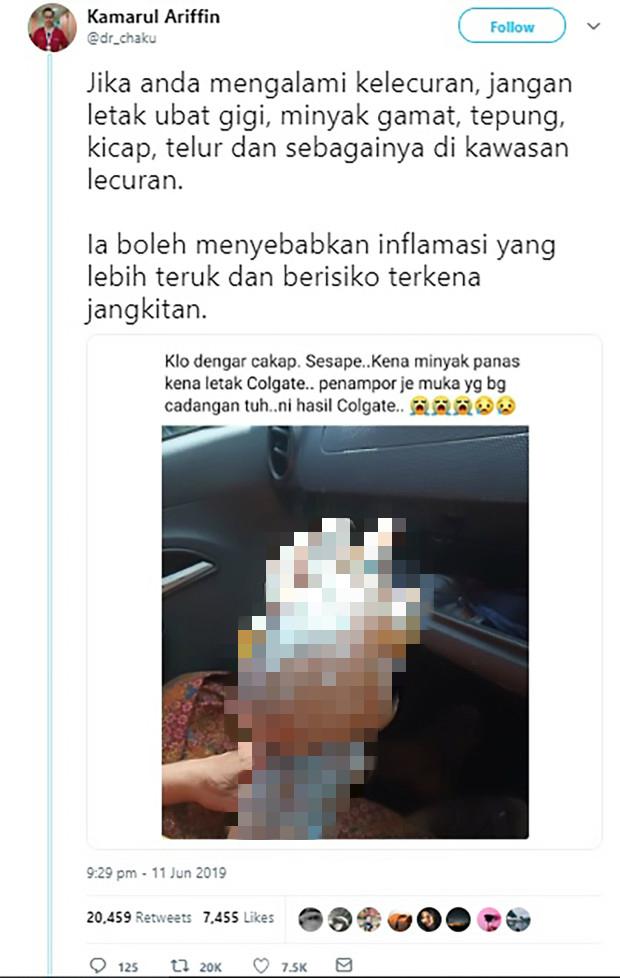 轻度烧伤用冷水冲洗后可涂抹牙膏,烧伤涂抹牙膏有用吗