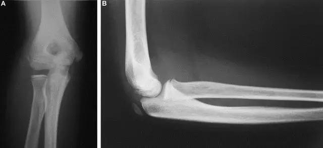 所有骨折都叫什么名字,骨折的名称有哪些