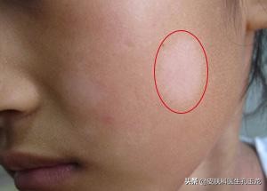 小孩脸上白色斑点和白癜风的区别,孩子脸上有白斑是虫斑还是白癜风