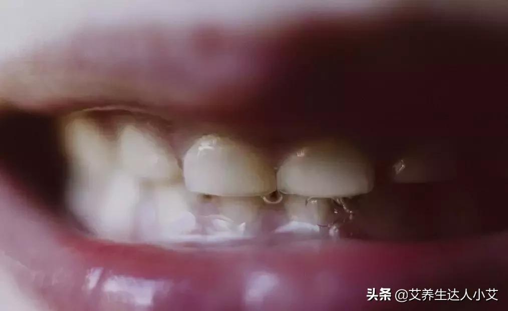 喉咙呼噜噜的痰音可预示五种疾病,什么样的痰预示有疾病