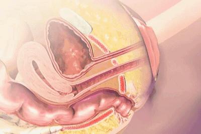 产后漏尿怎么避免尴尬,产后三年漏尿最有效的恢复方法