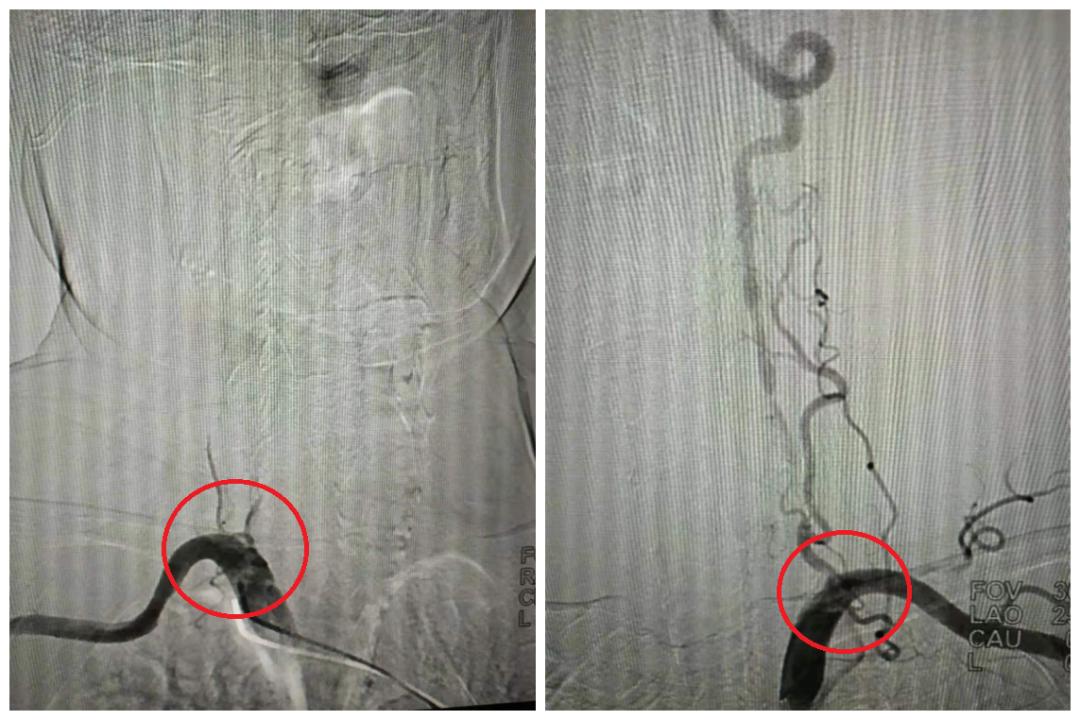 75岁老人多发性脑梗死,DSA介入治疗打通大脑“生命线”