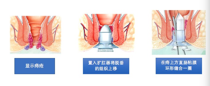 严重的痔疮用传统还是微创,生痔疮用什么药好呢