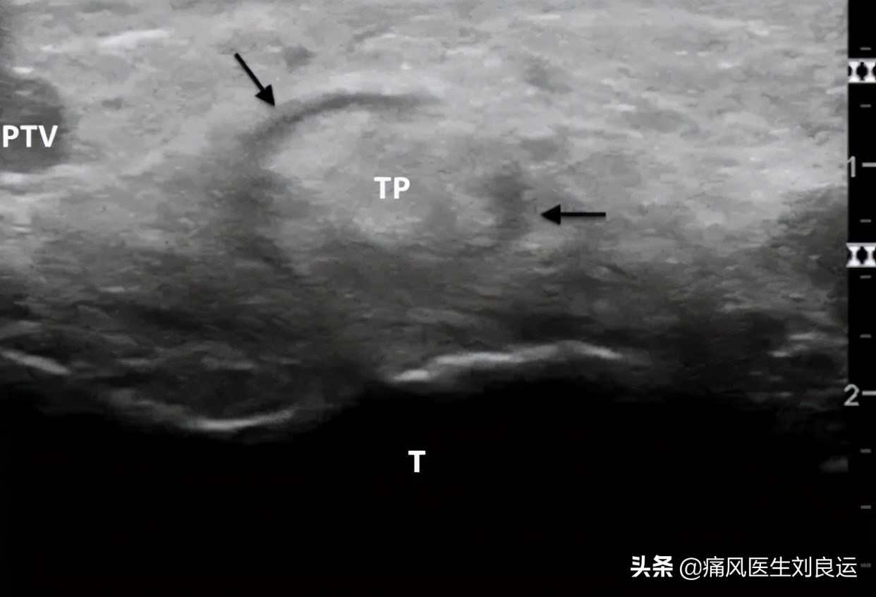 痛风引发腱鞘炎,痛风长出痛风石了怎么办