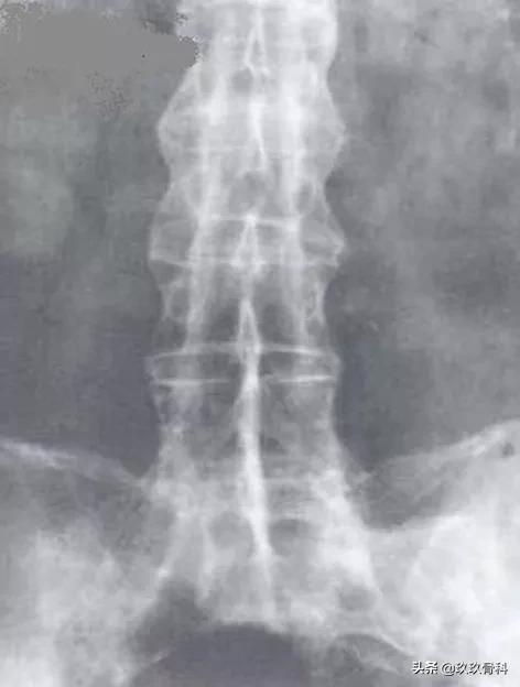 5岁小孩强直性脊柱炎的诊断,强直性脊柱炎诊断标准b27